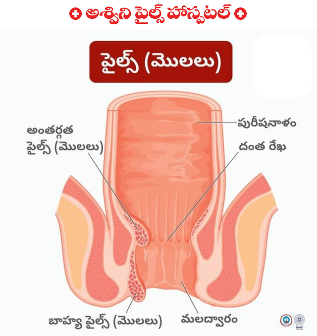 Anatomy of Piles