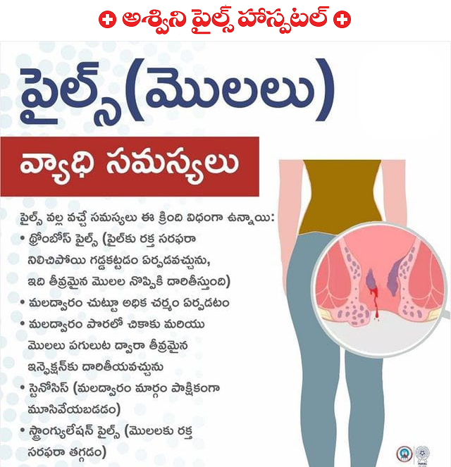 Complications of Piles