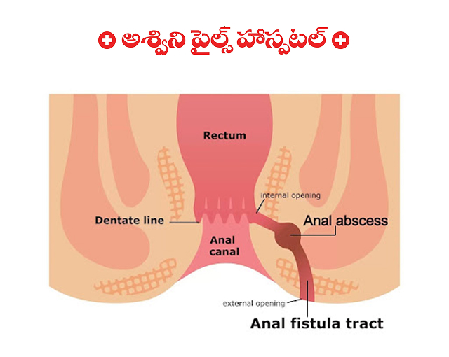 Complications of Piles