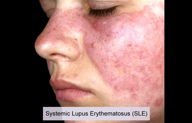 Systemic Lupus Erythematosus