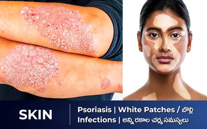 Skin Conditions