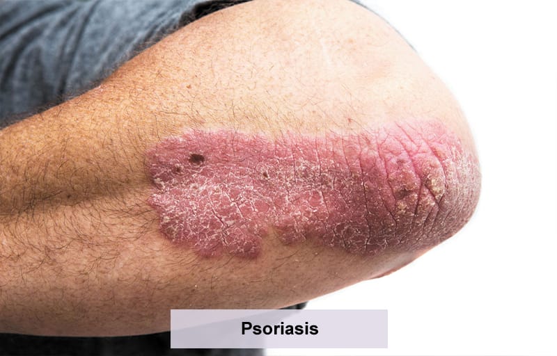Psoriasis