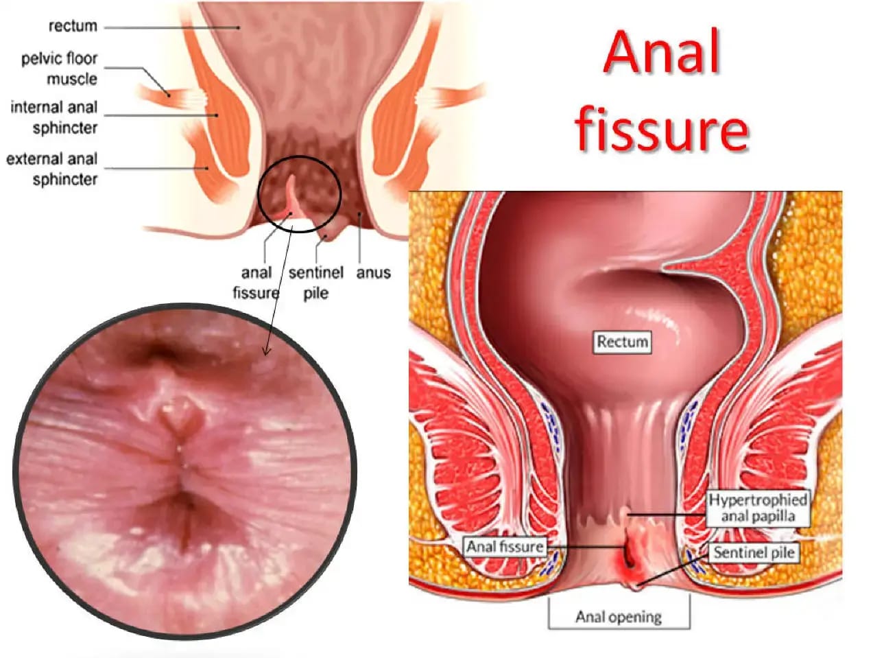 Anal fissure anatomy diagram
